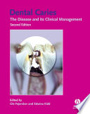 Dental caries : the disease and its clinical management