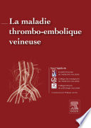 La maladie thrombo-embolique veineuse