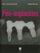 Péri-implantites