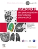 Imagerie des pneumopathies interstitielles diffuses (PID)